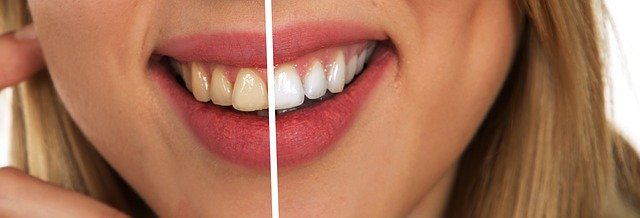 Pure whitening – dlhodobo biele zuby bez zbytočnej námahy!