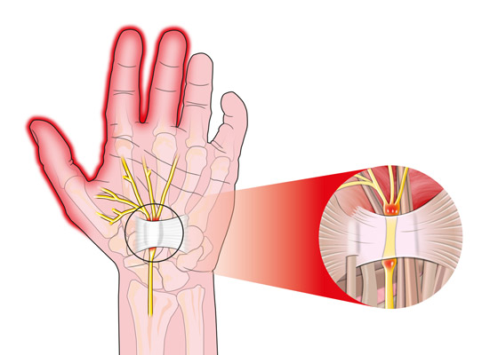 Syndróm karpálneho tunela – ako sa prejavuje a ako ho liečiť?